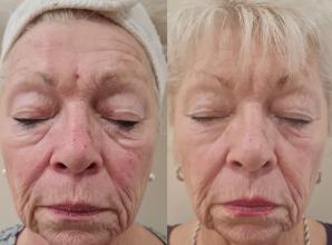 SPONSORED: Non-surgical facelifts in Maidenhead